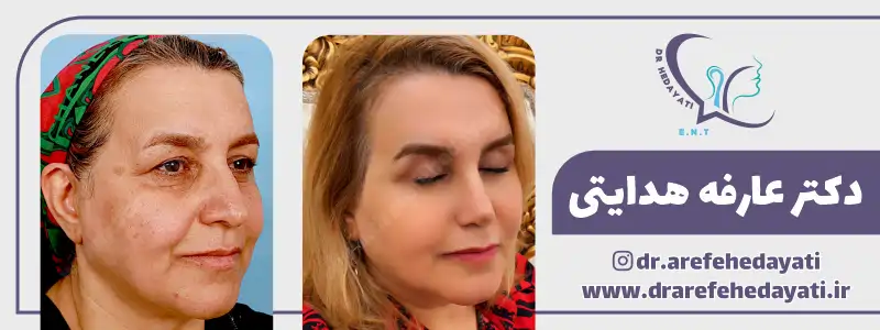 نمونه کار بلفاروپلاستی بهترین جراح پلک کرمانشاه
