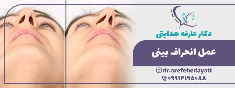 جراحی انحراف بینی