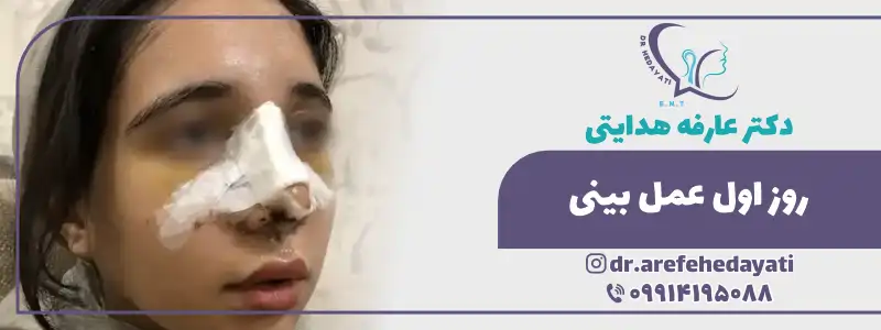 عکس از روز اول عمل بینی