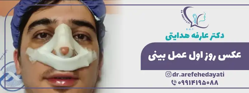 عکس روز اول عمل بینی