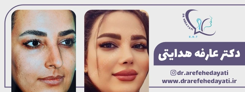نمونه کار بهترین جراح بینی کرمانشاه: دکتر عارفه هدایتی
