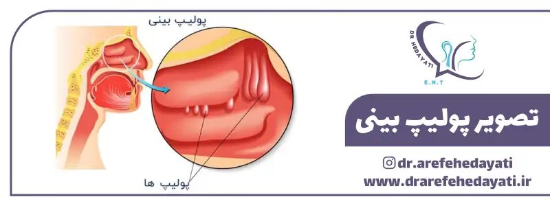 تصویر پولیپ بینی