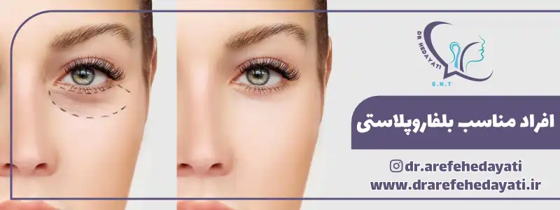 افراد مناسب بلفاروپلاستی