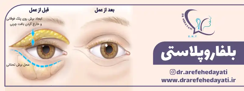 جراحی بلفاروپلاستی