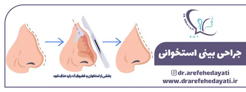 جراحی بینی استخوانی کرمانشاه