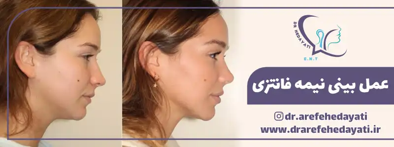 نمونه عمل بینی نیمه فانتزی