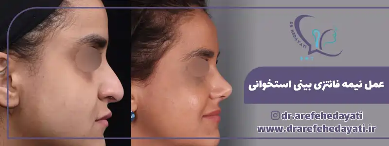 مدل نیمه فانتزی بینی استخوانی