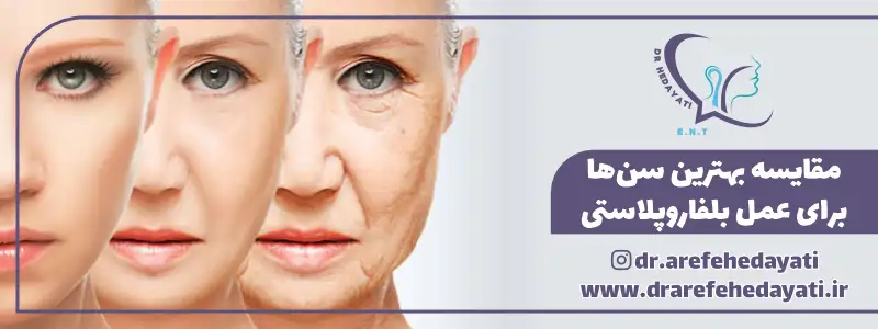 مقایسه بهترین سن ها برای عمل بلفاروپلاستی