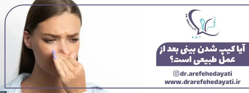 آیا کیپ شدن بینی بعد از عمل طبیعی است