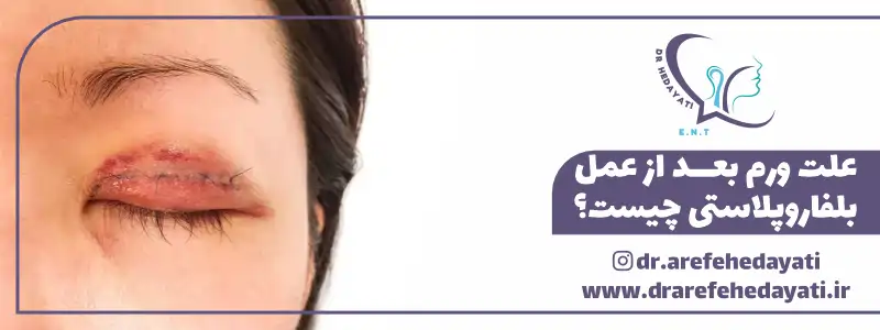 علت ورم بعد از عمل بلفاروپلاستی چیست؟