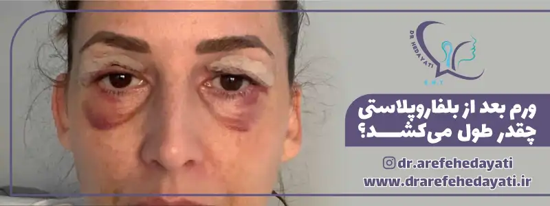 ورم بعد از بلفاروپلاستی چقدر طول می کشد؟