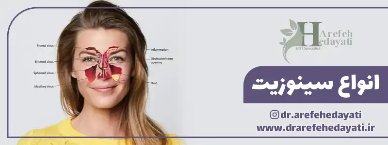 انواع سینوزیت