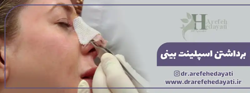 برداشتن گچ بینی