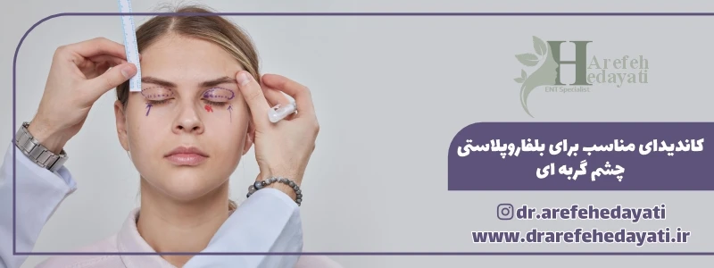 کاندیدای مناسب برای بلفاروپلاستی چشم گربه ای
