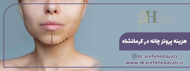 هزینه پروتز چانه در کرمانشاه