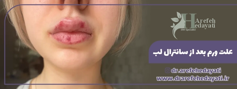 علت ورم بعد از سانترال لب