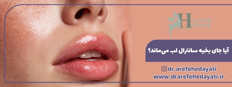 آیا جای بخیه سانترال لب می_ماند؟