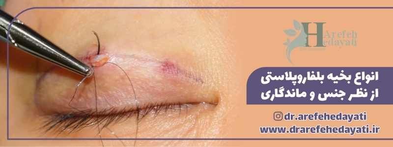 انواع بخیه بلفاروپلاستی از نظر جنس و ماندگاری