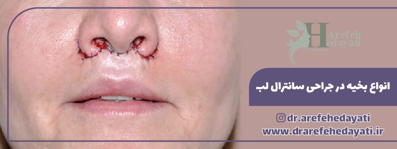 انواع بخیه در جراحی سانترال لب