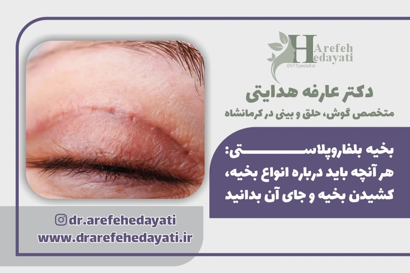 بخیه بلفاروپلاستی هر آنچه باید درباره انواع بخیه، کشیدن بخیه و جای آن بدانید
