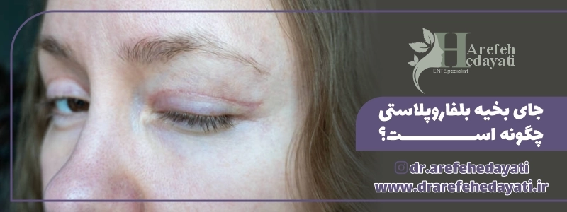 جای بخیه بلفاروپلاستی چگونه است؟