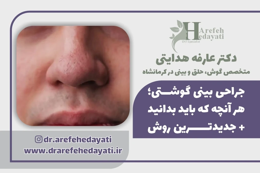 جراحی بینی گوشتی هر آنچه که باید بدانید جدیدترین روش