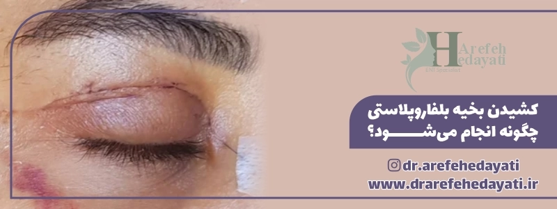 کشیدن بخیه بلفاروپلاستی چگونه انجام می_شود؟