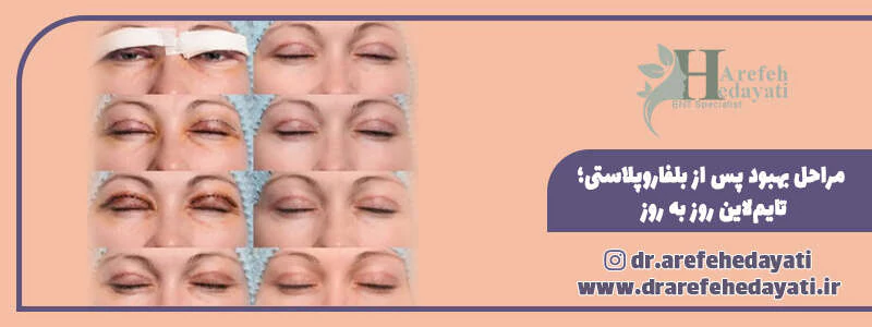 مراحل بهبود پس از بلفاروپلاستی؛ تایم‌لاین روز به روز