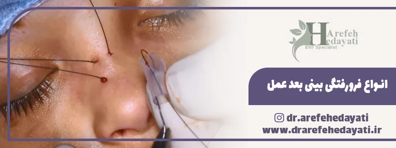 انواع فرورفتگی بینی بعد عمل