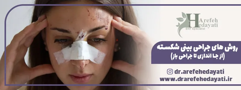 روش های جراحی بینی شکسته (از جا اندازی تا جراحی باز)