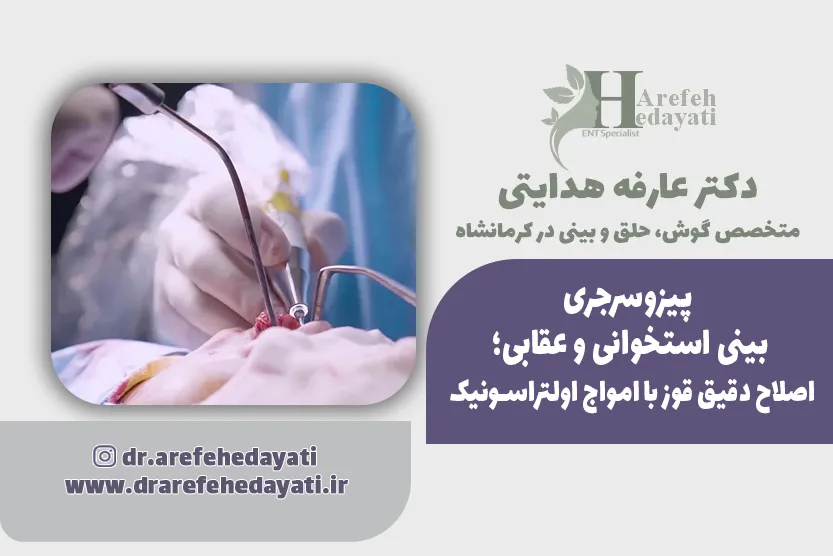 پیزوسرجری بینی استخوانی و عقابی؛ اصلاح دقیق قوز با امواج اولتراسونیک